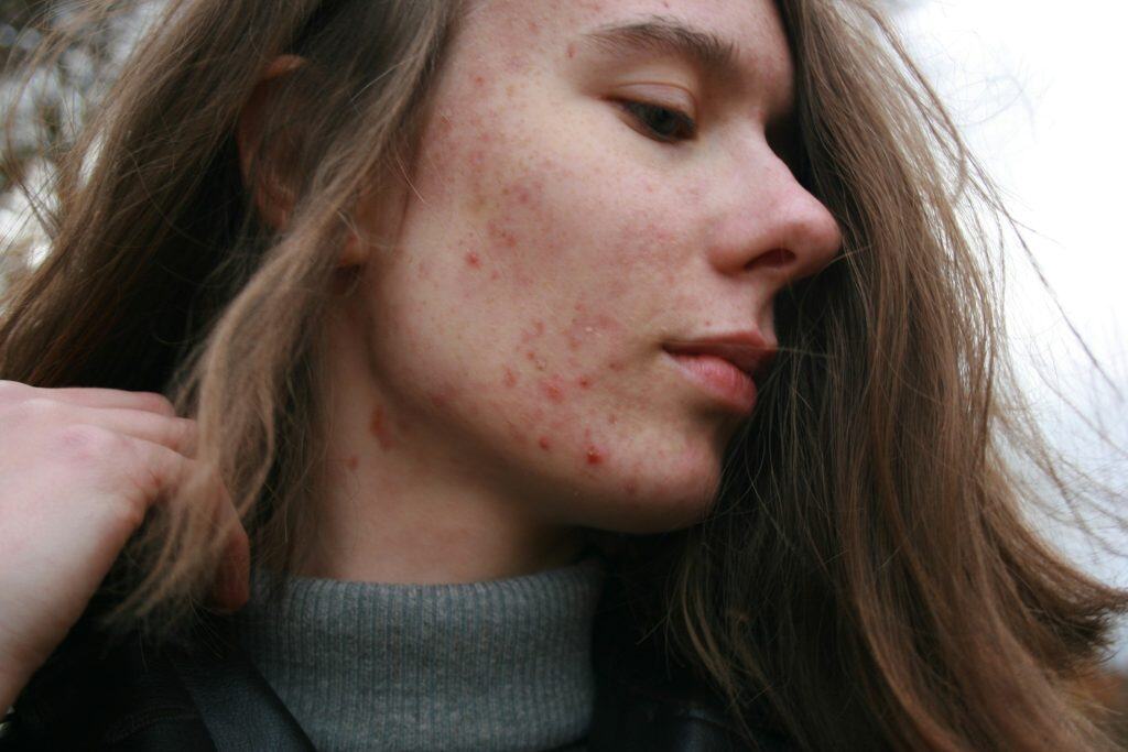 Clear skin with acne scars, young woman outdoors, natural skincare, dermatology, skincare treatment, acne recovery, beauty, skincare routine, healthy skin, natural beauty.