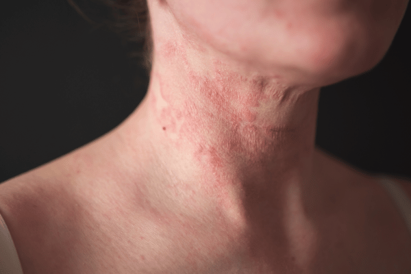 Natural Eczema Treatment by an Accredited Naturopath