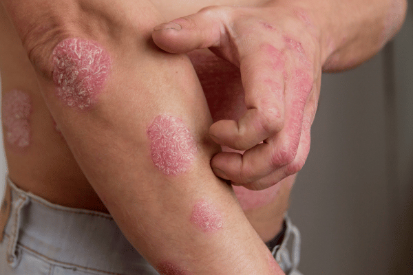 Psoriasis Naturopath Brisbane