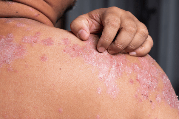 Psoriasis Naturopathy Brisbane