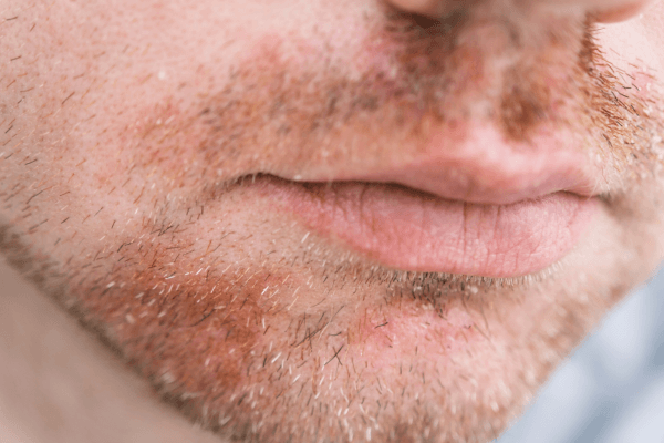 Seborrheic Dermatitis Naturopath Brisbane