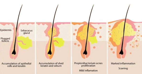 Acne Naturopath Brisbane