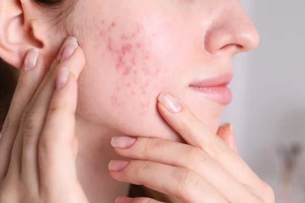 Naturopathy for Acne in Brisbane